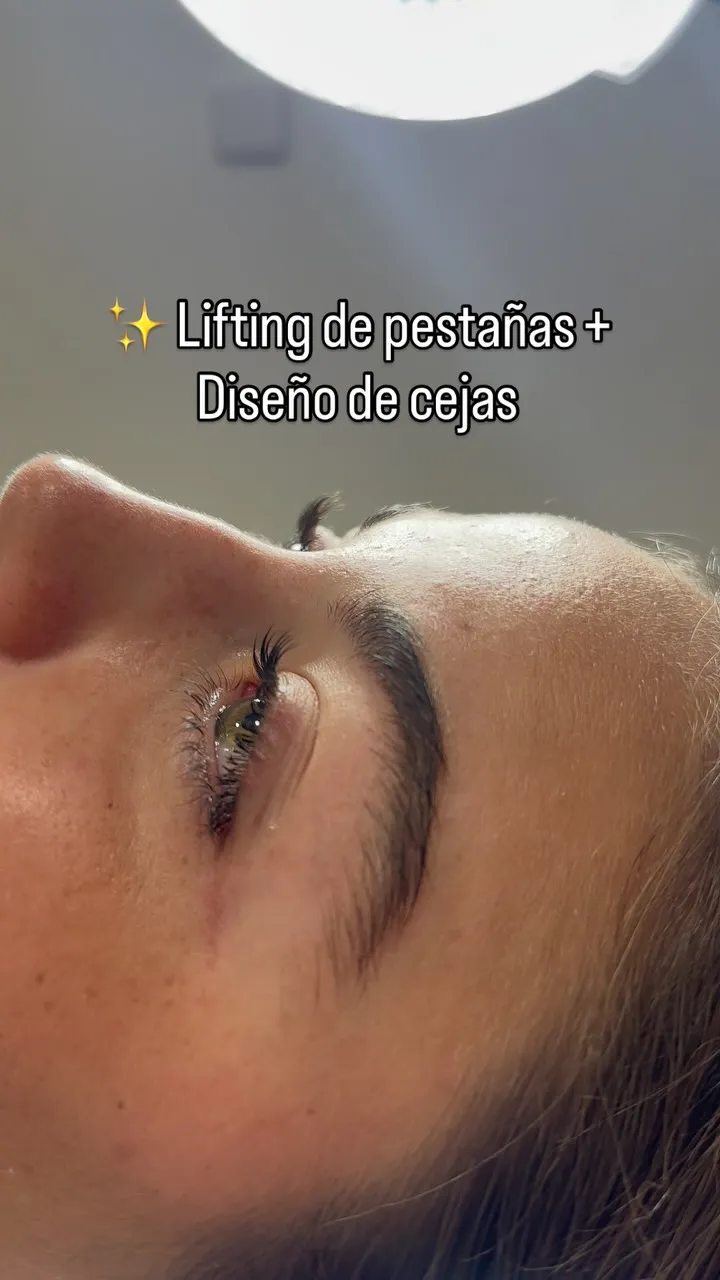 Radiofrecuencia facial