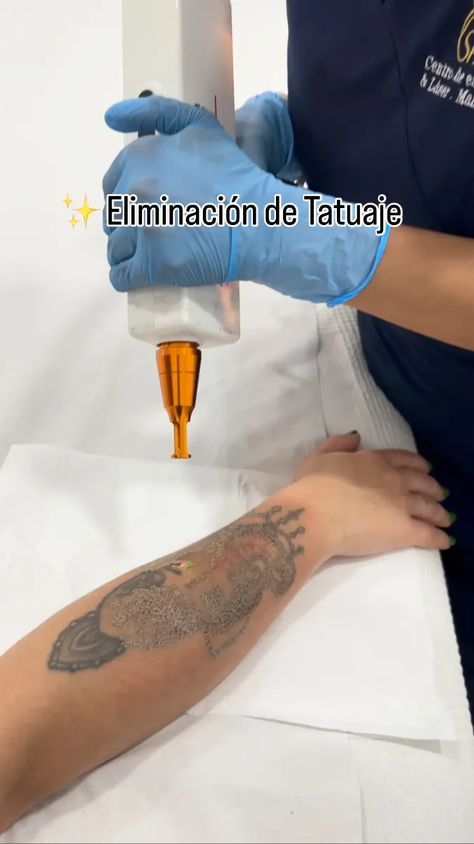 Eliminación de tatuajes